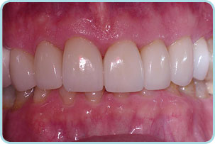 cosmetic-dentistry-after